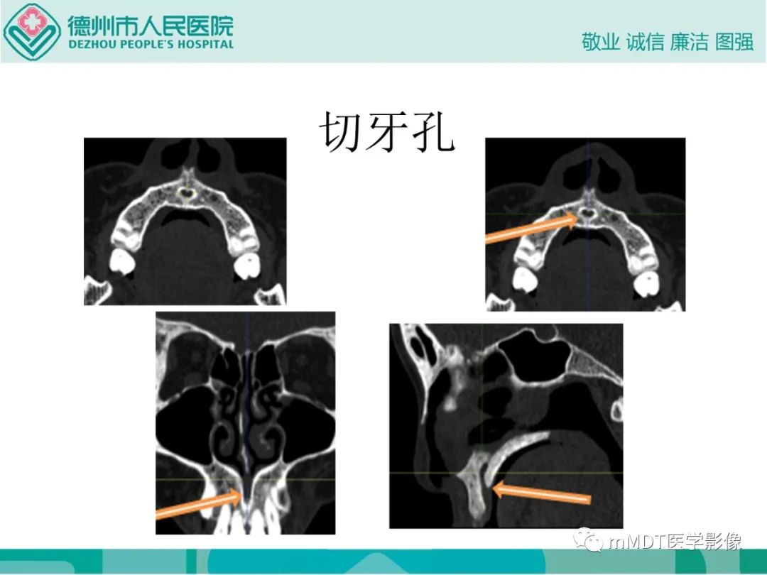 影像PPT - 【PPT】绕出崎岖孔孔道—三叉神经的颅底走形-86