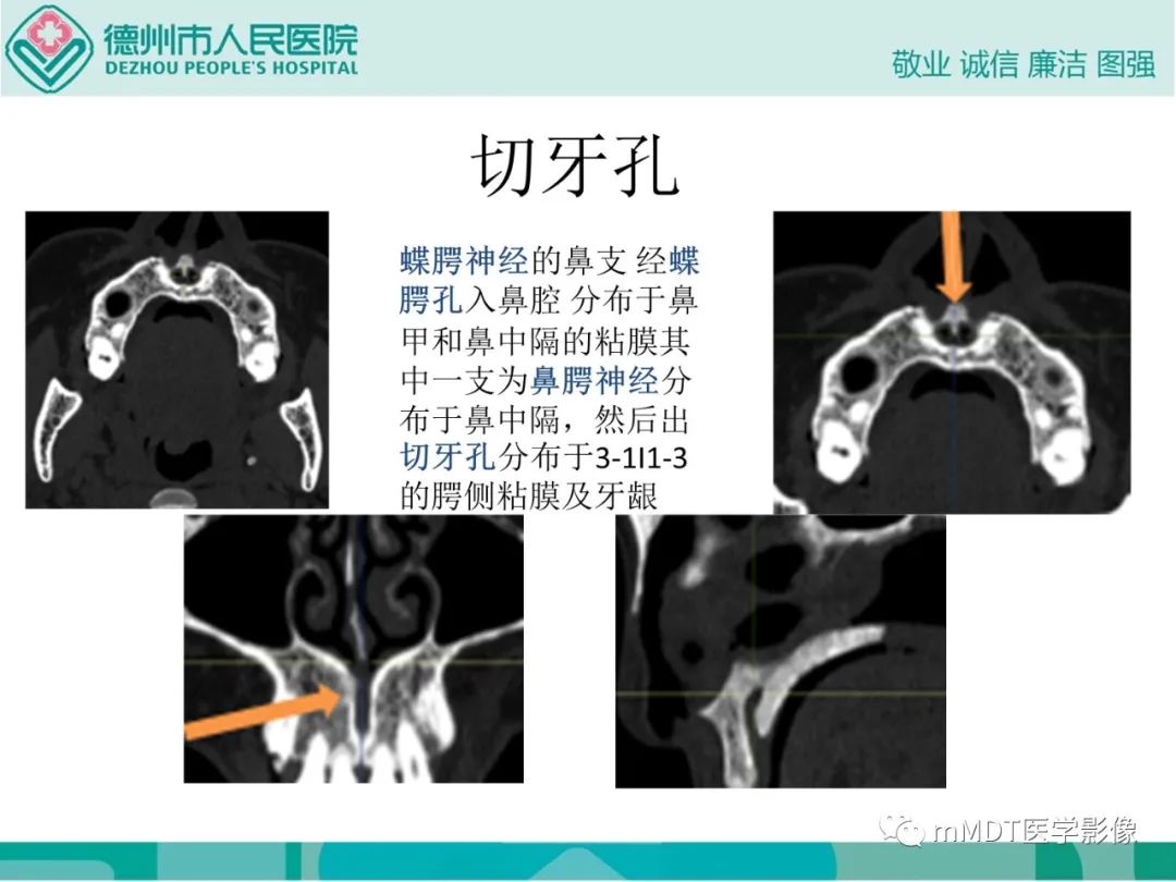 影像PPT - 【PPT】绕出崎岖孔孔道—三叉神经的颅底走形-87