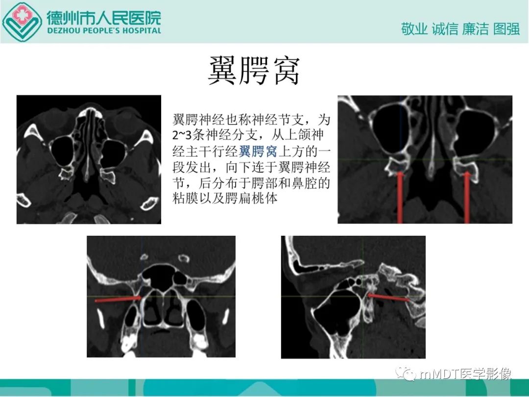 影像PPT - 【PPT】绕出崎岖孔孔道—三叉神经的颅底走形-88