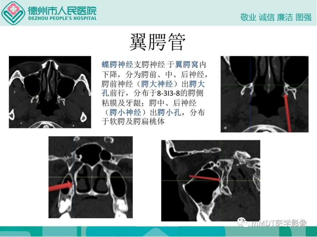 影像PPT - 【PPT】绕出崎岖孔孔道—三叉神经的颅底走形-89