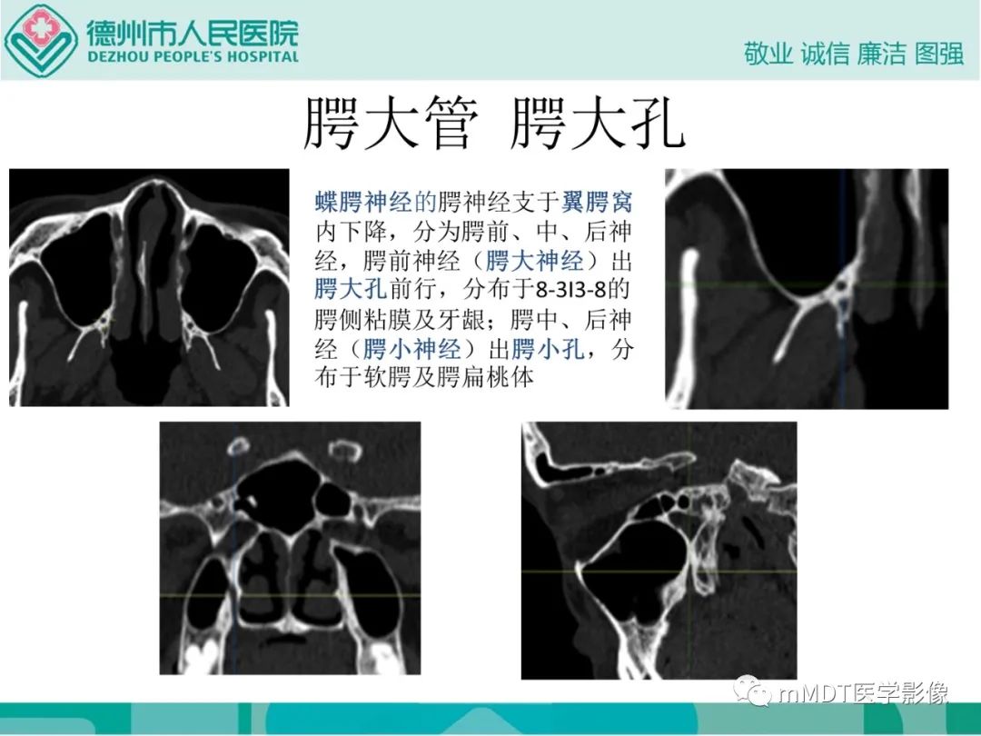 影像PPT - 【PPT】绕出崎岖孔孔道—三叉神经的颅底走形-91