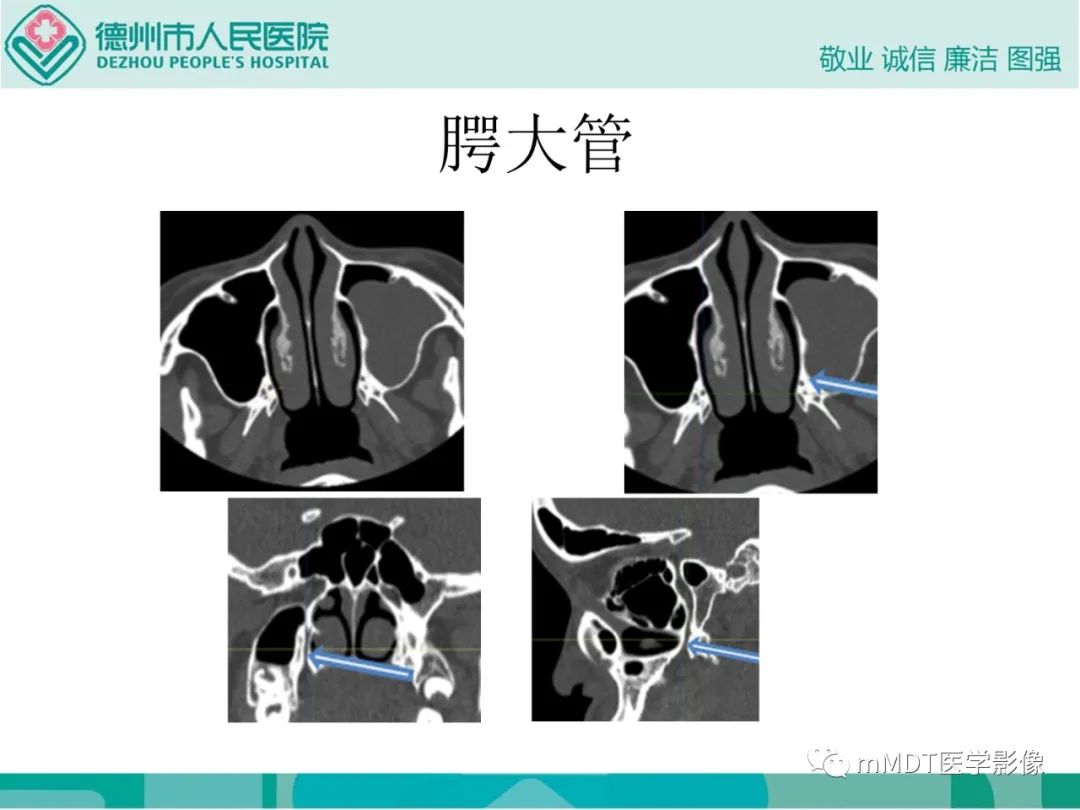 影像PPT - 【PPT】绕出崎岖孔孔道—三叉神经的颅底走形-93