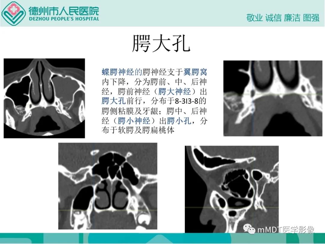 影像PPT - 【PPT】绕出崎岖孔孔道—三叉神经的颅底走形-94