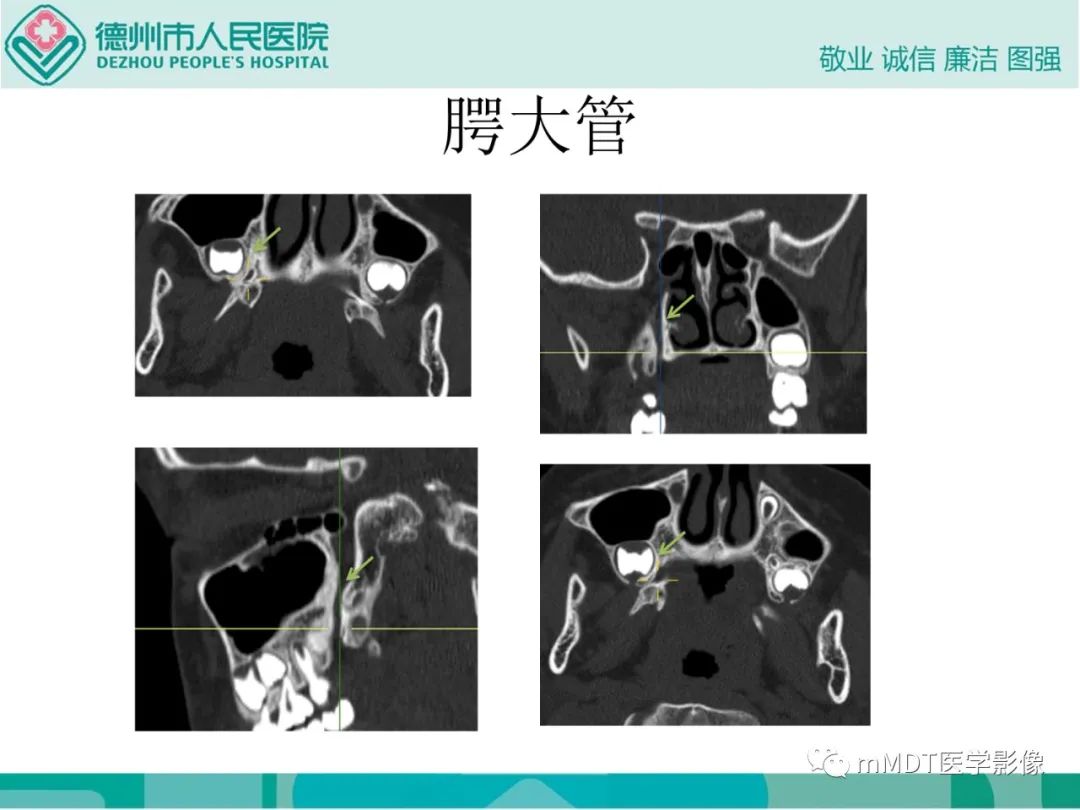 影像PPT - 【PPT】绕出崎岖孔孔道—三叉神经的颅底走形-95