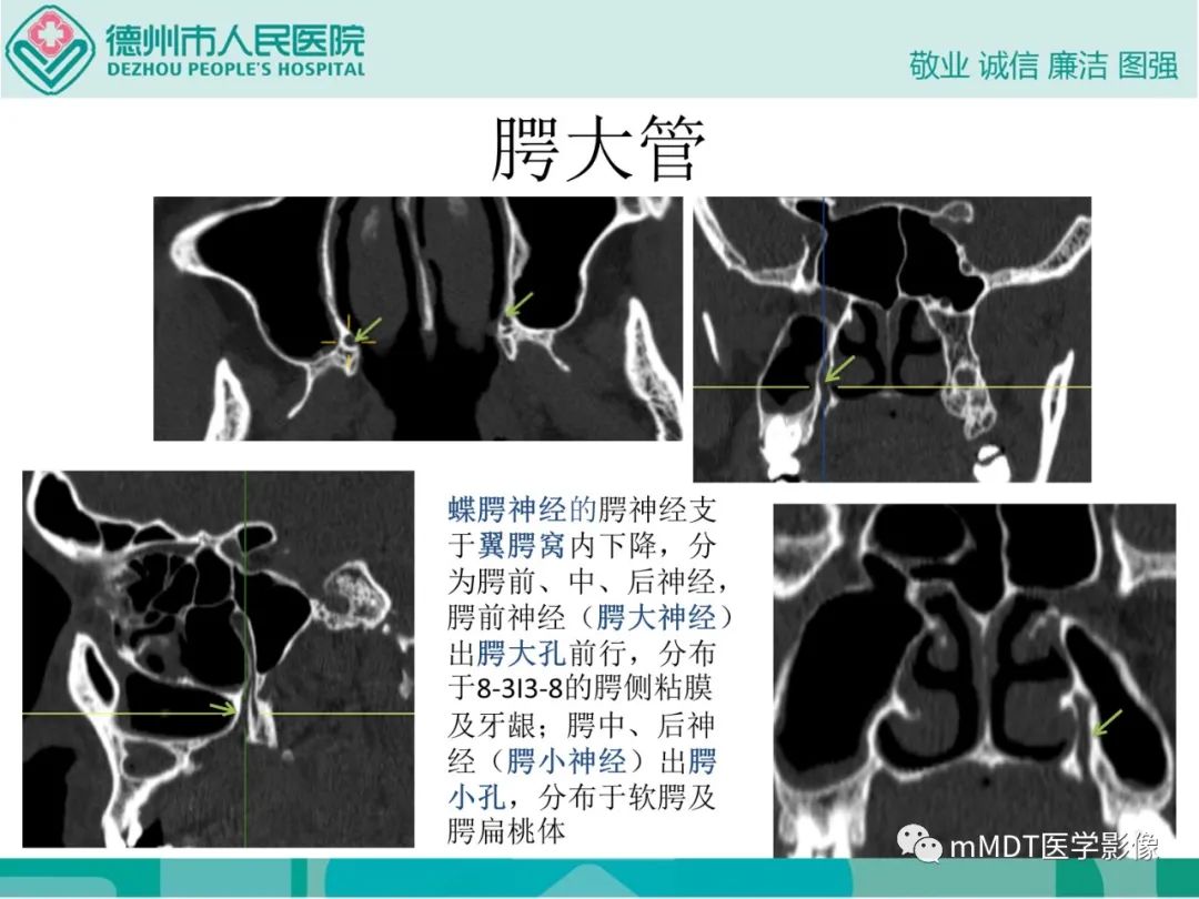 影像PPT - 【PPT】绕出崎岖孔孔道—三叉神经的颅底走形-96