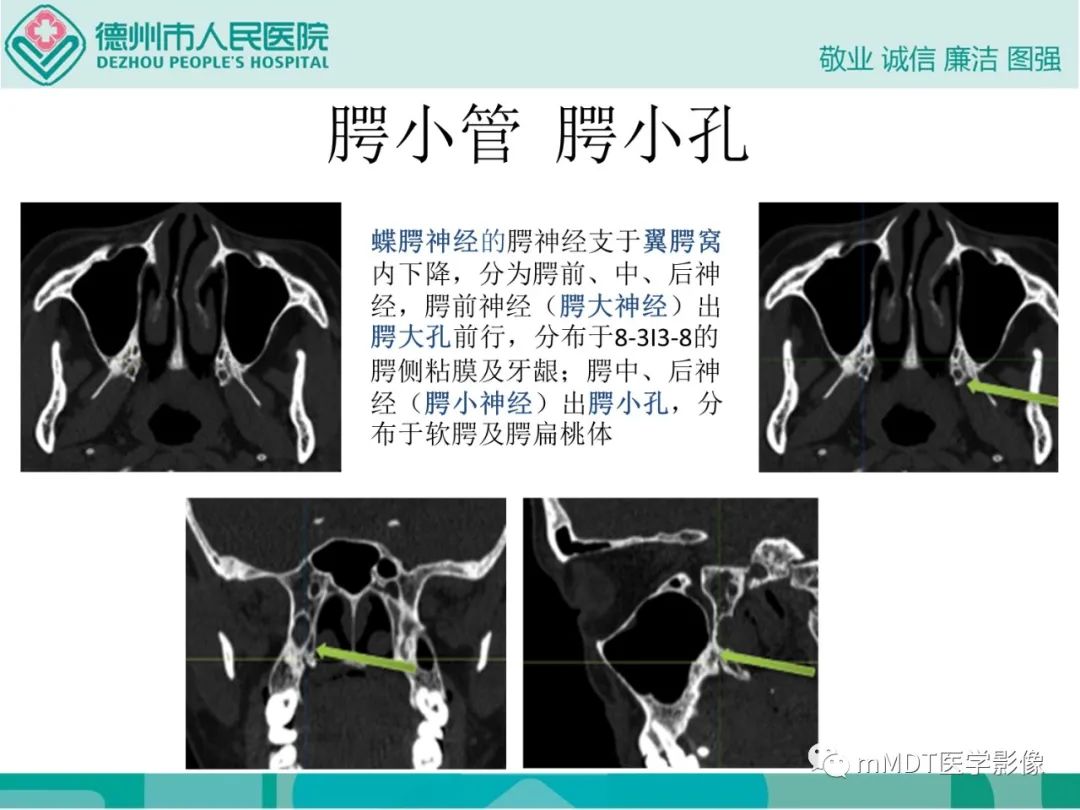 影像PPT - 【PPT】绕出崎岖孔孔道—三叉神经的颅底走形-97