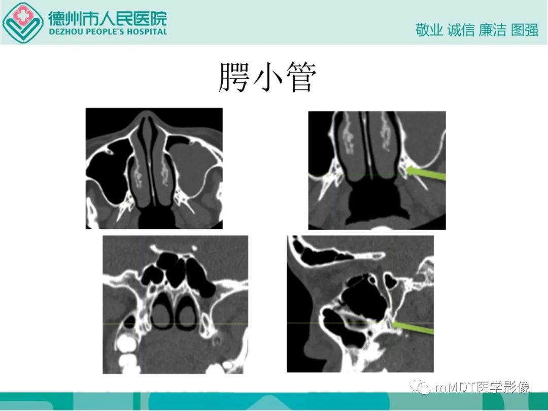 影像PPT - 【PPT】绕出崎岖孔孔道—三叉神经的颅底走形-98