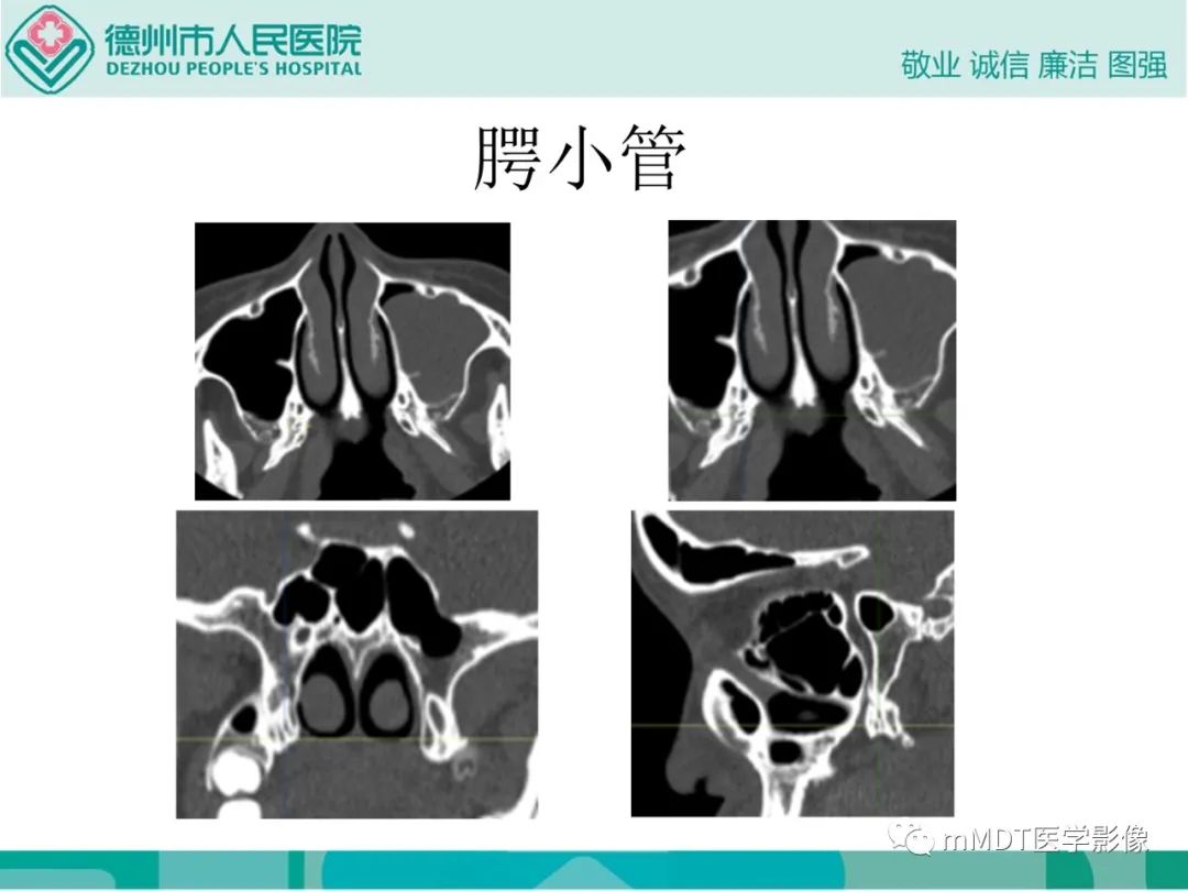 影像PPT - 【PPT】绕出崎岖孔孔道—三叉神经的颅底走形-99