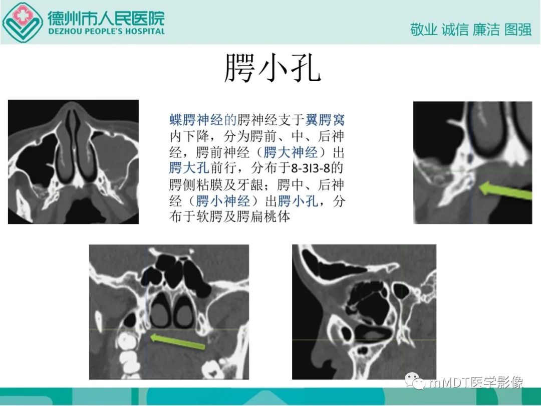 影像PPT - 【PPT】绕出崎岖孔孔道—三叉神经的颅底走形-100