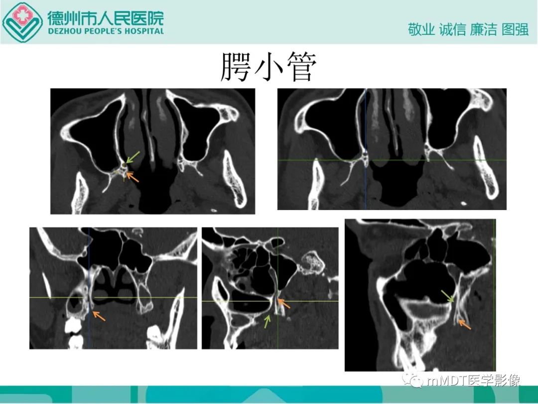 影像PPT - 【PPT】绕出崎岖孔孔道—三叉神经的颅底走形-101