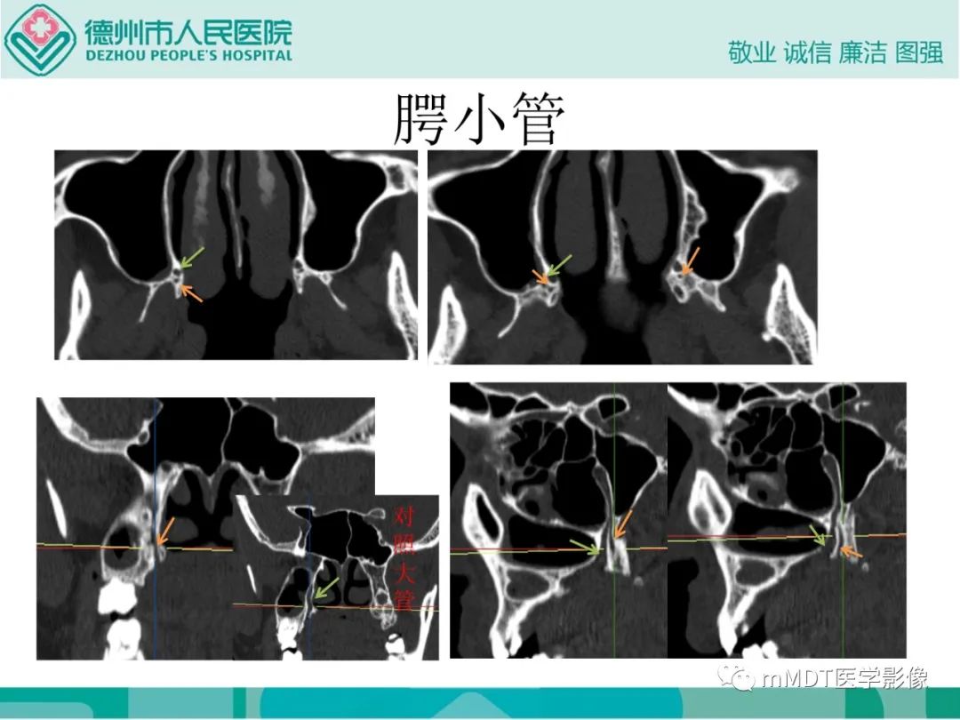 影像PPT - 【PPT】绕出崎岖孔孔道—三叉神经的颅底走形-102