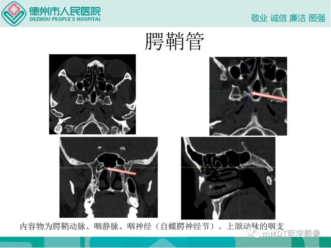 影像PPT - 【PPT】绕出崎岖孔孔道—三叉神经的颅底走形-104