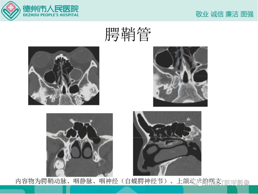 影像PPT - 【PPT】绕出崎岖孔孔道—三叉神经的颅底走形-105