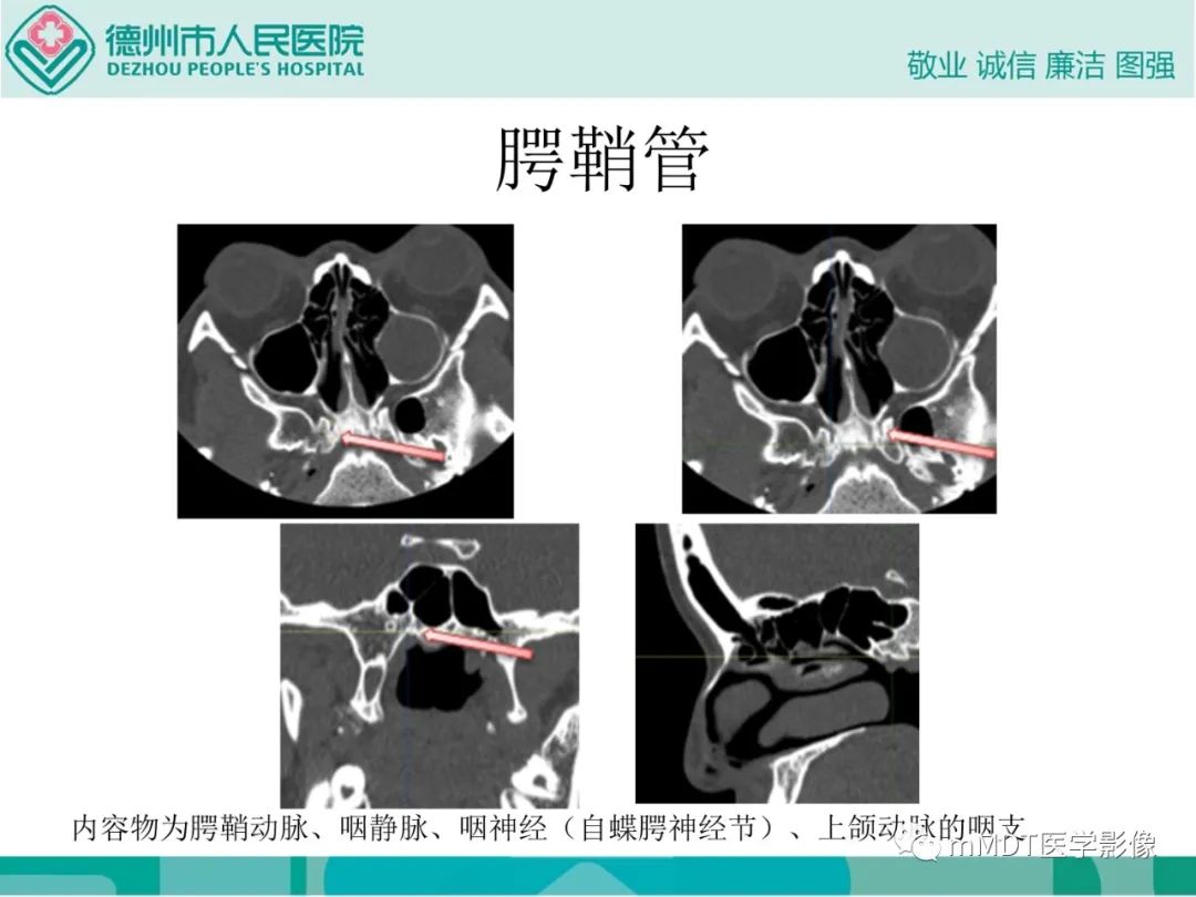 影像PPT - 【PPT】绕出崎岖孔孔道—三叉神经的颅底走形-106