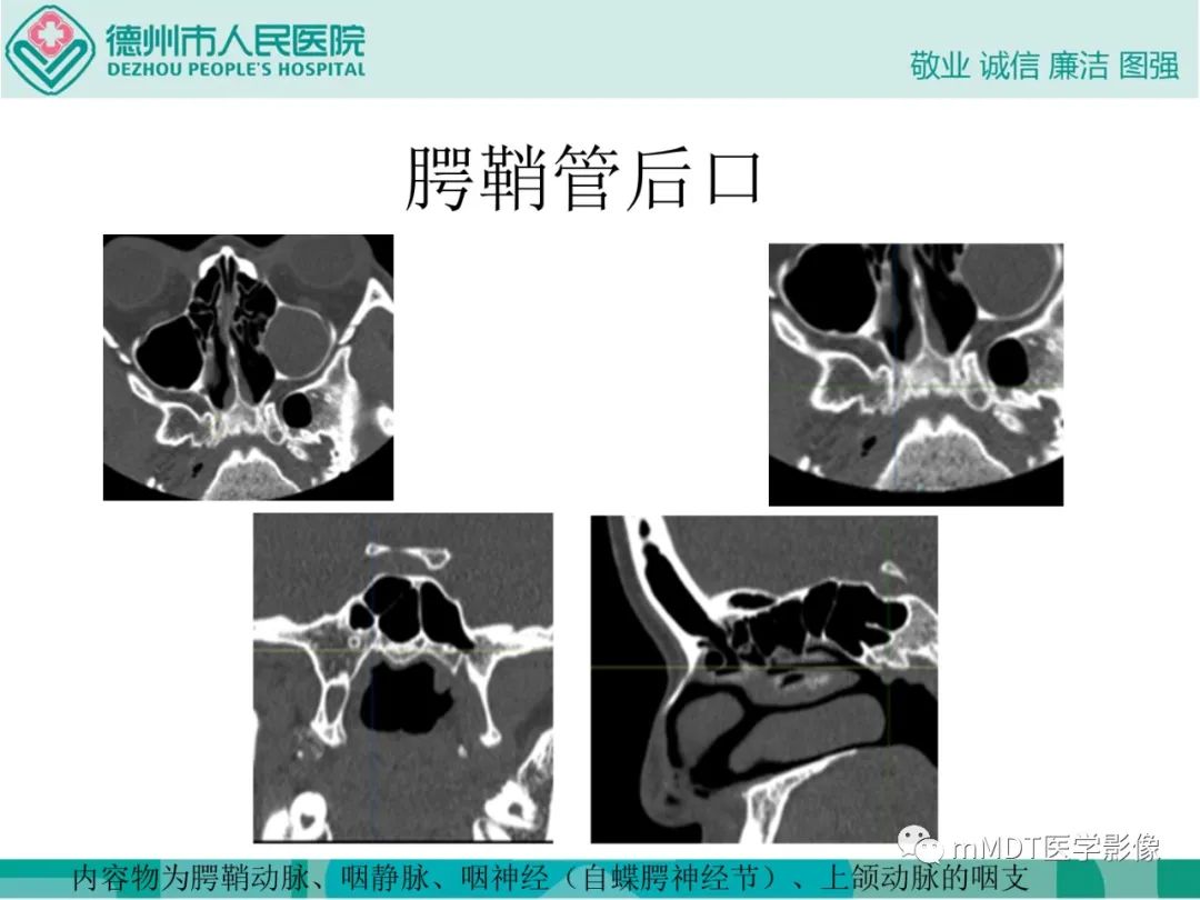 影像PPT - 【PPT】绕出崎岖孔孔道—三叉神经的颅底走形-107