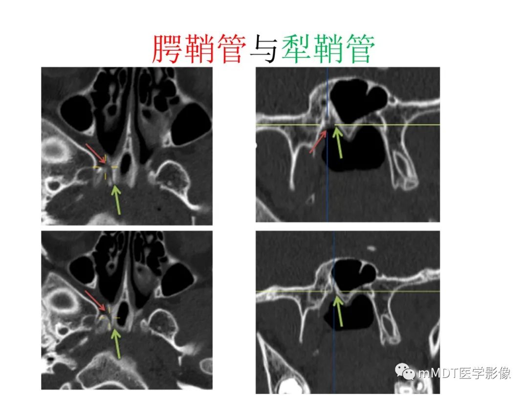 影像PPT - 【PPT】绕出崎岖孔孔道—三叉神经的颅底走形-110