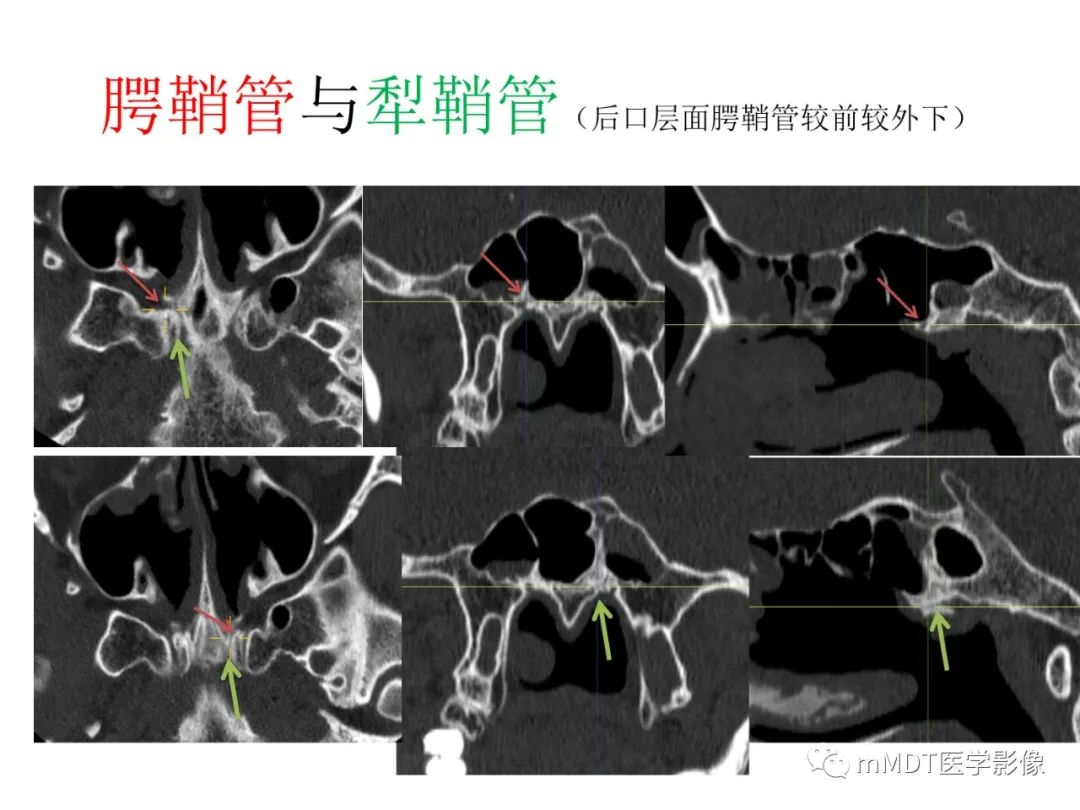 影像PPT - 【PPT】绕出崎岖孔孔道—三叉神经的颅底走形-112