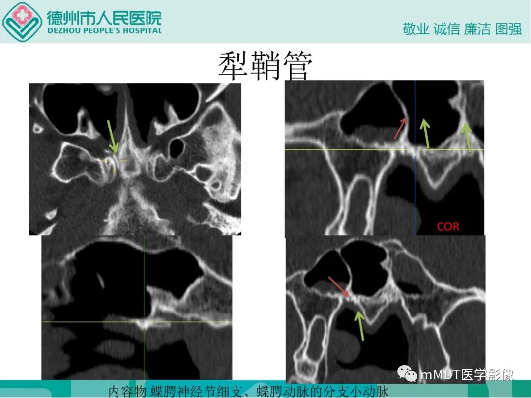 影像PPT - 【PPT】绕出崎岖孔孔道—三叉神经的颅底走形-113