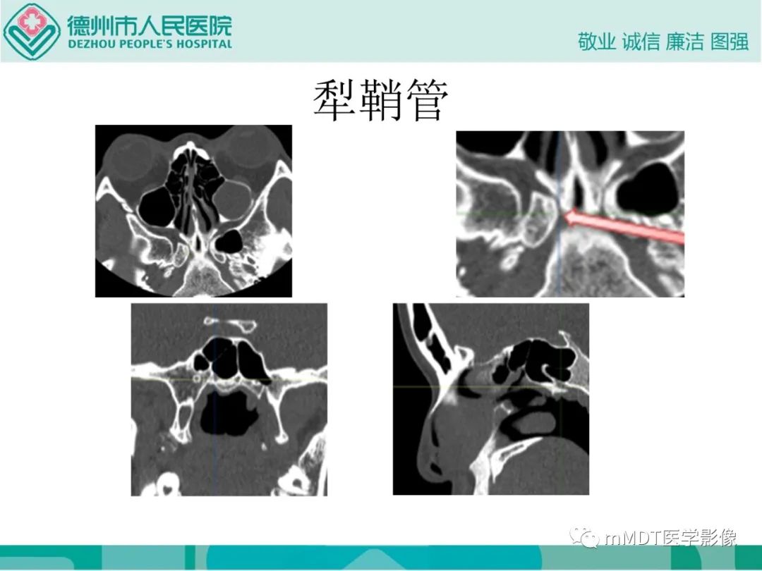 影像PPT - 【PPT】绕出崎岖孔孔道—三叉神经的颅底走形-114