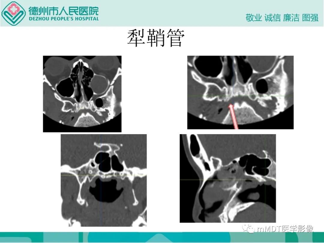 影像PPT - 【PPT】绕出崎岖孔孔道—三叉神经的颅底走形-115