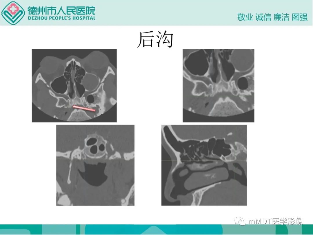 影像PPT - 【PPT】绕出崎岖孔孔道—三叉神经的颅底走形-116