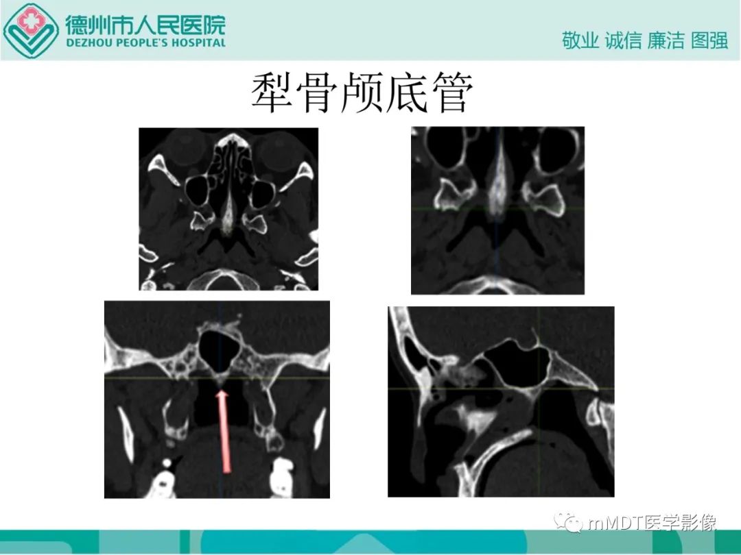 影像PPT - 【PPT】绕出崎岖孔孔道—三叉神经的颅底走形-117