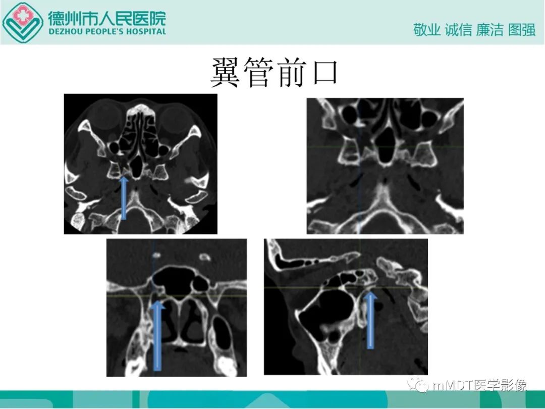 影像PPT - 【PPT】绕出崎岖孔孔道—三叉神经的颅底走形-118