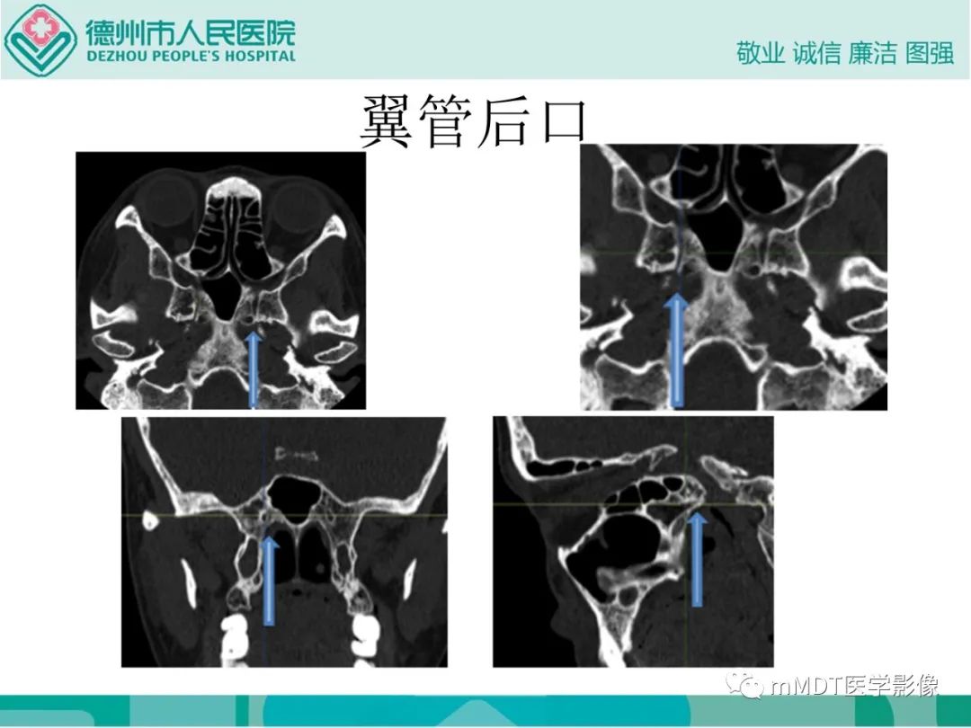 影像PPT - 【PPT】绕出崎岖孔孔道—三叉神经的颅底走形-120