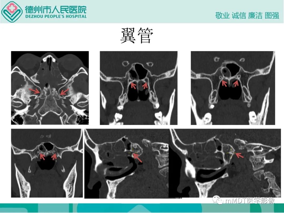 影像PPT - 【PPT】绕出崎岖孔孔道—三叉神经的颅底走形-121