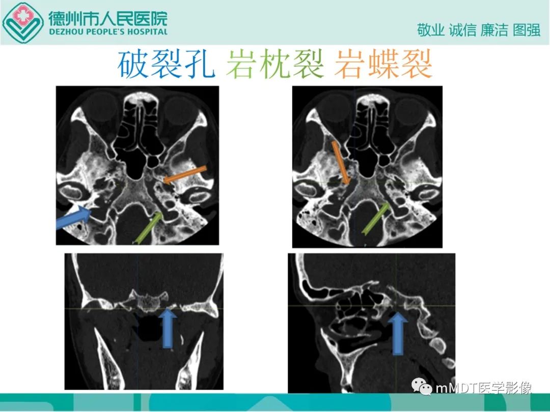 影像PPT - 【PPT】绕出崎岖孔孔道—三叉神经的颅底走形-123