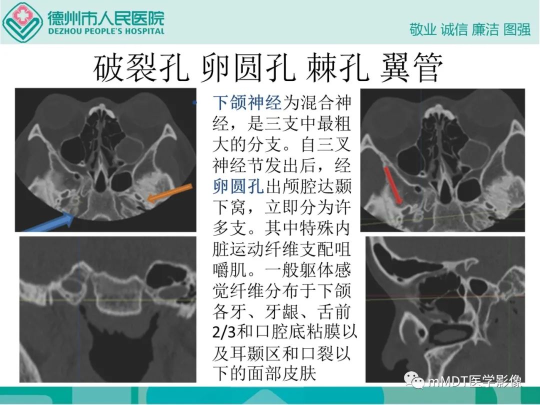 影像PPT - 【PPT】绕出崎岖孔孔道—三叉神经的颅底走形-124