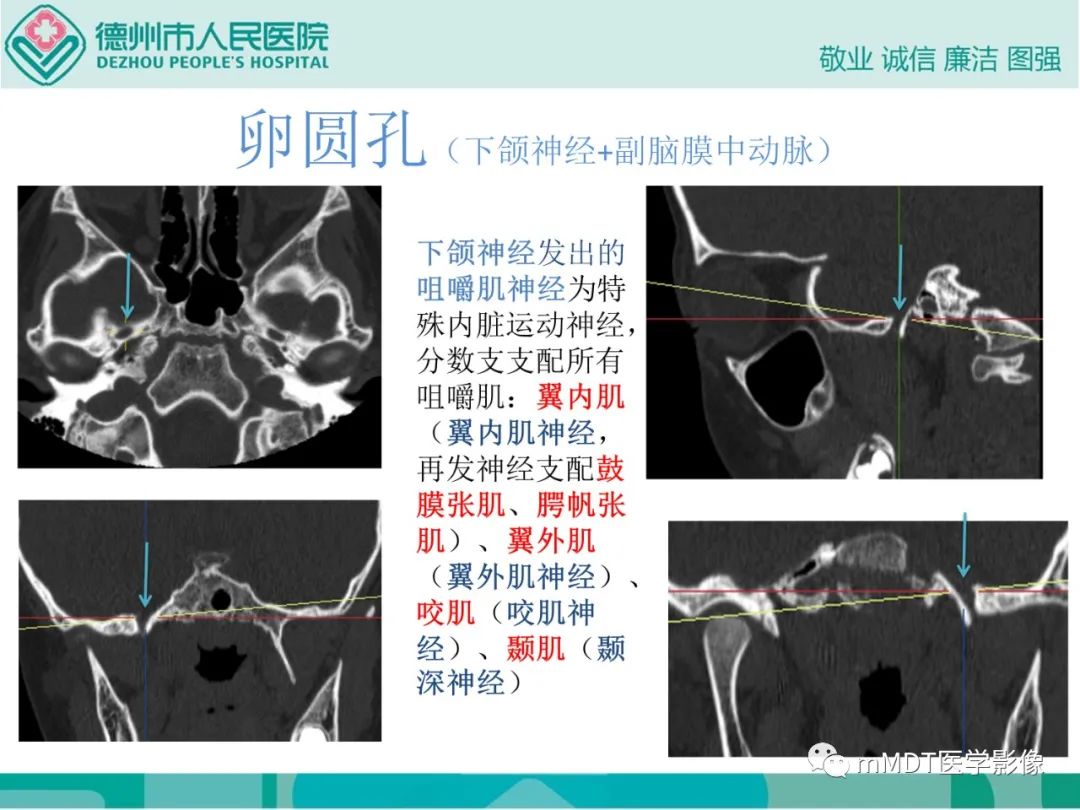 影像PPT - 【PPT】绕出崎岖孔孔道—三叉神经的颅底走形-125