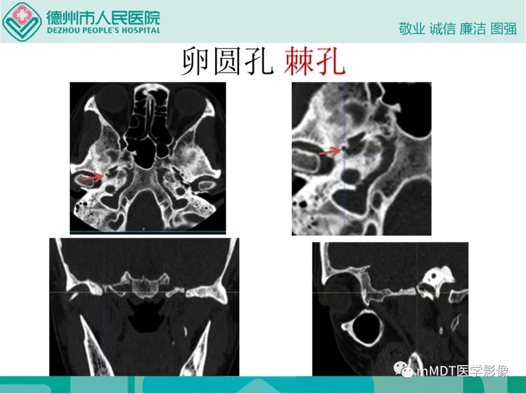 影像PPT - 【PPT】绕出崎岖孔孔道—三叉神经的颅底走形-126