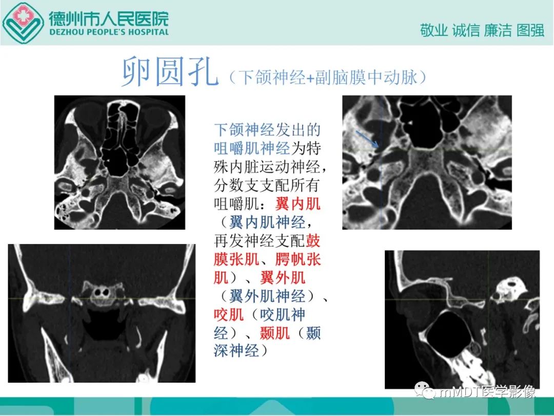 影像PPT - 【PPT】绕出崎岖孔孔道—三叉神经的颅底走形-127