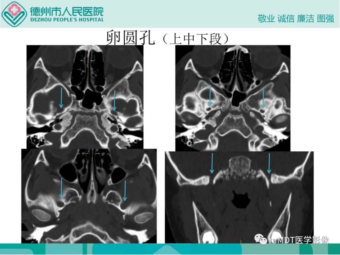 影像PPT - 【PPT】绕出崎岖孔孔道—三叉神经的颅底走形-129