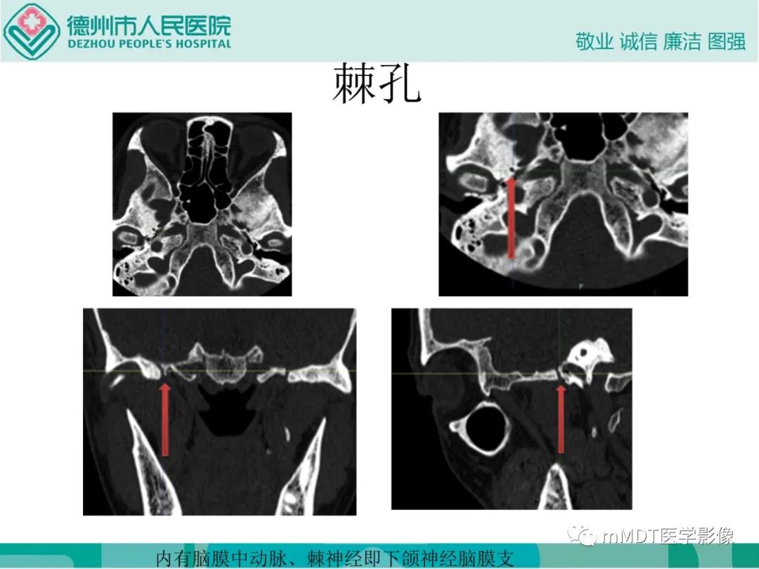 影像PPT - 【PPT】绕出崎岖孔孔道—三叉神经的颅底走形-128