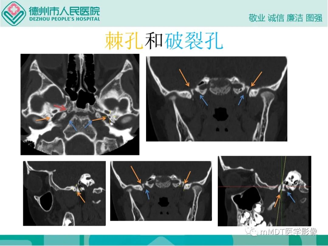 影像PPT - 【PPT】绕出崎岖孔孔道—三叉神经的颅底走形-130