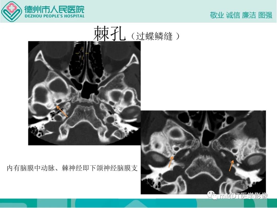 影像PPT - 【PPT】绕出崎岖孔孔道—三叉神经的颅底走形-131