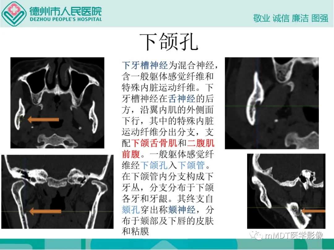 影像PPT - 【PPT】绕出崎岖孔孔道—三叉神经的颅底走形-132