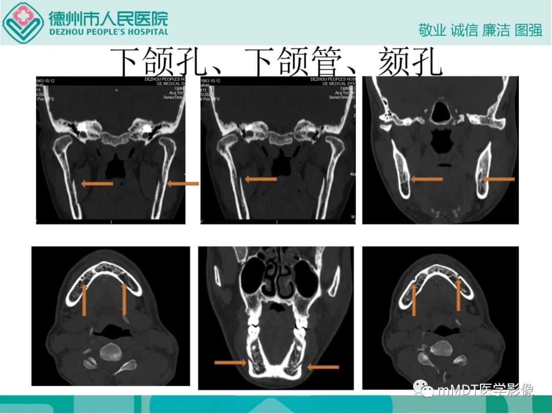 影像PPT - 【PPT】绕出崎岖孔孔道—三叉神经的颅底走形-134