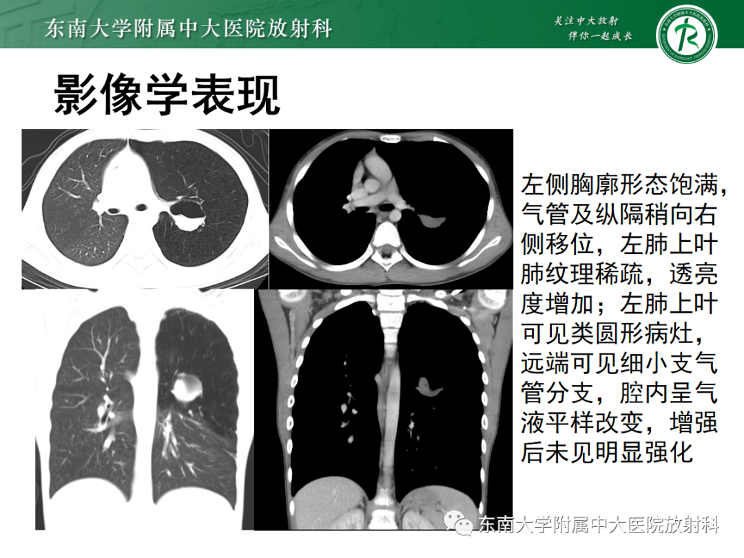 影像PPT - 【PPT】先天性支气管闭锁-4