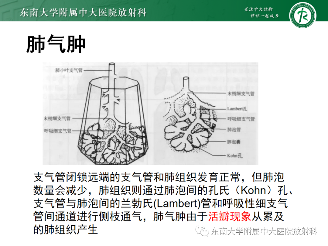 影像PPT - 【PPT】先天性支气管闭锁-10