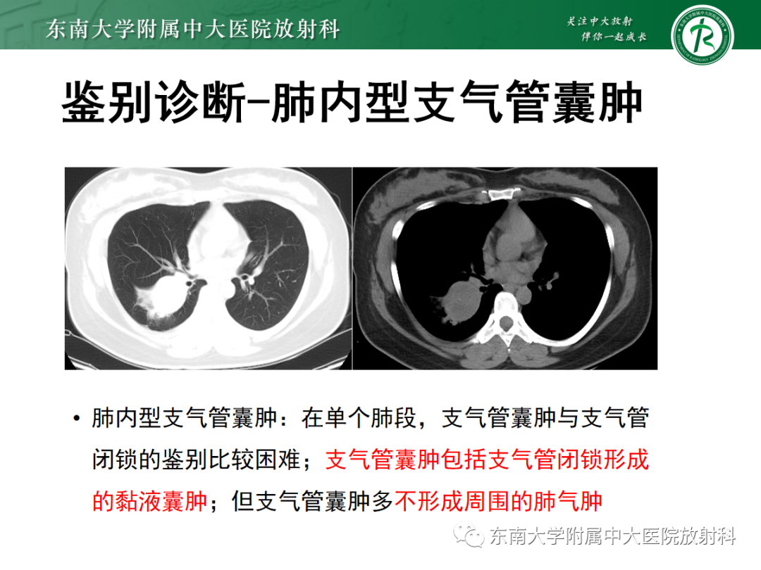 影像PPT - 【PPT】先天性支气管闭锁-17