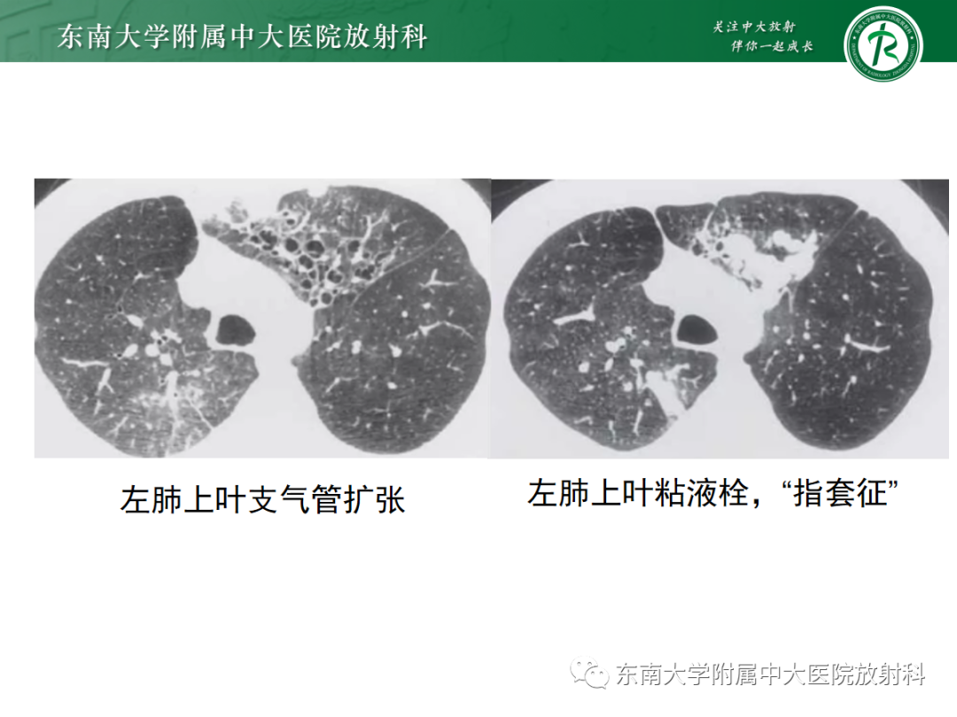 影像PPT - 【PPT】先天性支气管闭锁-21