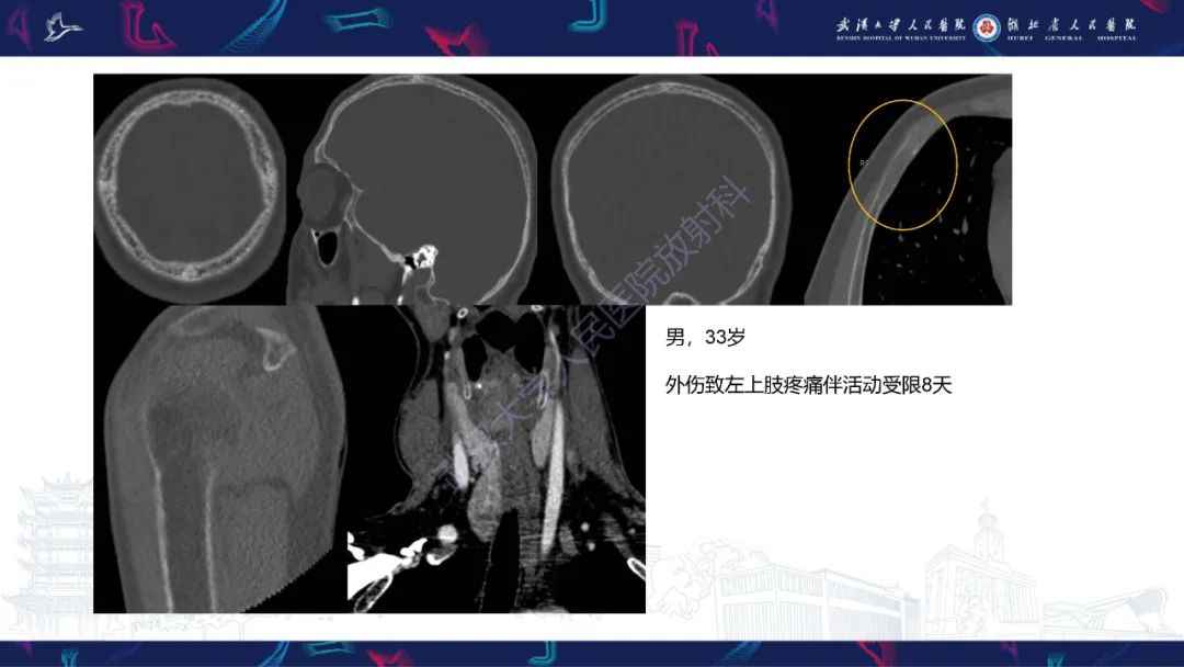 影像PPT - 【PPT】颅骨弥漫性病变影像诊断-9