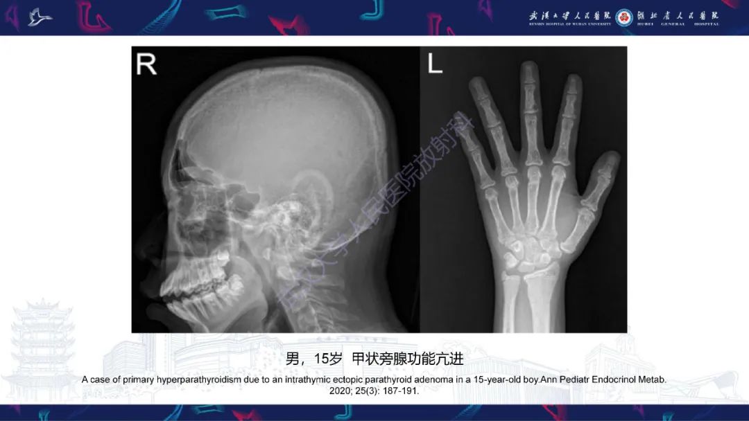 影像PPT - 【PPT】颅骨弥漫性病变影像诊断-14