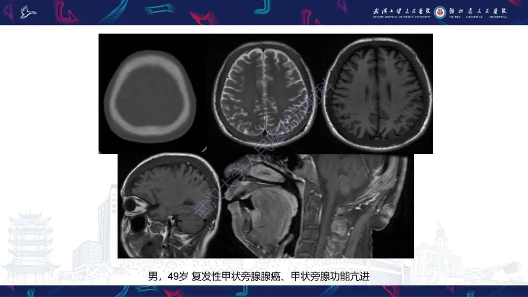 影像PPT - 【PPT】颅骨弥漫性病变影像诊断-15