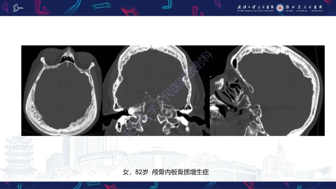 影像PPT - 【PPT】颅骨弥漫性病变影像诊断-20