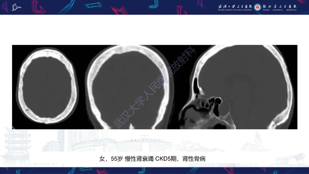 影像PPT - 【PPT】颅骨弥漫性病变影像诊断-18