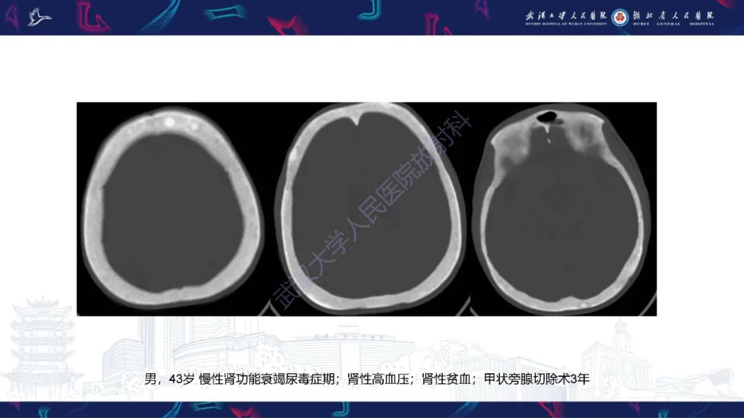 影像PPT - 【PPT】颅骨弥漫性病变影像诊断-17